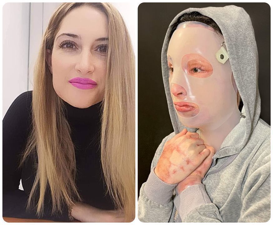 Ιωάννα Παλιοσπύρου: Σοκαριστικές φωτογραφίες από το χειρουργείο μετά την επίθεση με βιτριόλι-Πολύ σκληρές εικόνες