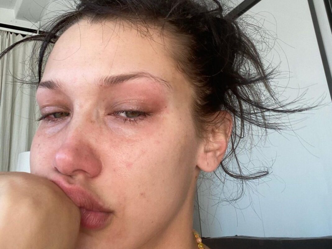 Bella Hadid: Η μάχη με την χρόνια κατάθλιψη και οι αδημοσίευτες φωτογραφίες με δάκρυα στα μάτια
