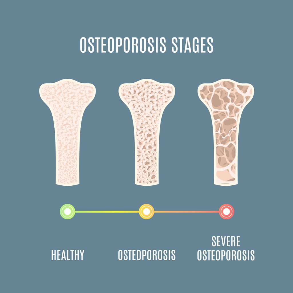 Μέτρηση οστικής μάζας: Γρήγορη, μη επεμβατική εξέταση για τη διάγνωση της οστεοπόρωσης