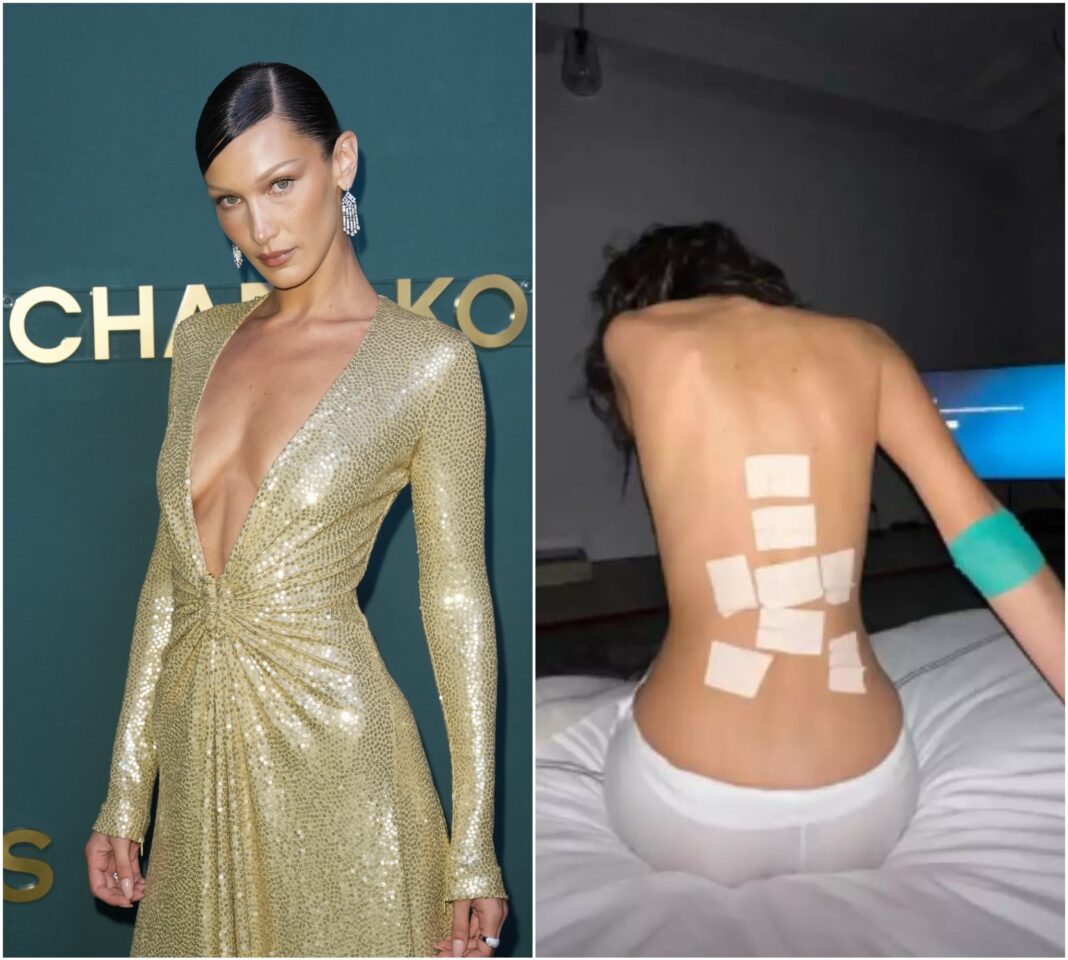 Bella Hadid: Μεγάλη ανησυχία για την υγεία του μοντέλου! Οι φωτογραφίες από το νοσοκομείο και οι γάζες στο σώμα της