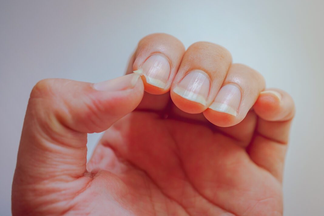 Αυτή είναι η καλύτερη θεραπεία για κατεστραμμένα νύχια που πρέπει να δοκιμάσεις!