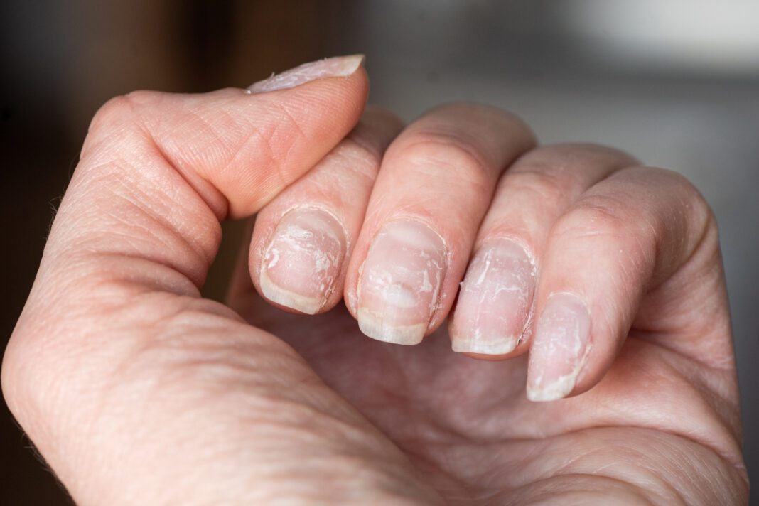 Κατεστραμμένα νύχια: Εύκολοι τρόποι για να τα φροντίσεις!