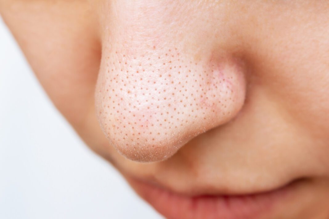 Πώς να αντιμετωπίσεις τα μαύρα στίγματα στην μύτη σου με 3 φυσικά συστατικά!